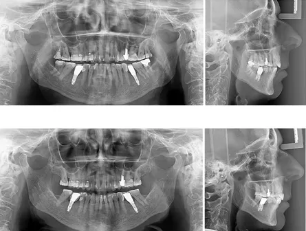 Tratamento ortodôntico-reabilitador de Classe II em paciente com implantes